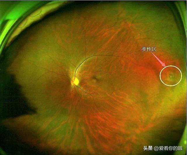 视网膜色素变性最新疗法，突破与创新带来希望之光